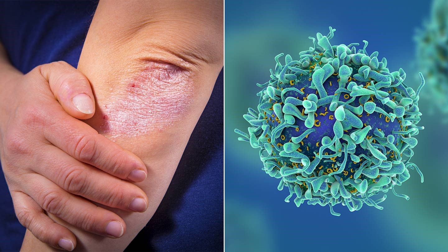 Как научиться контролировать псориаз