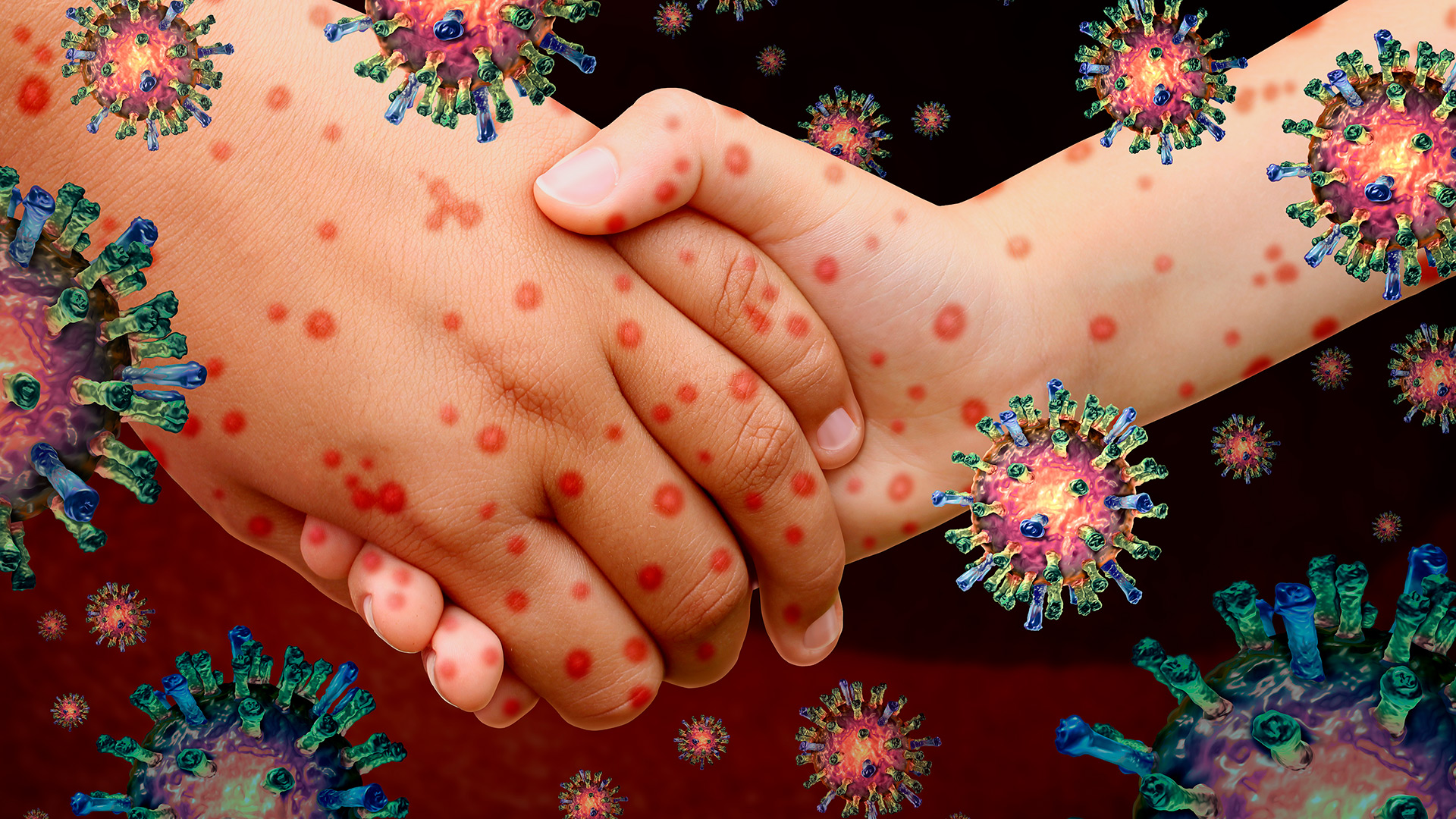 ЭНТЕРОВИРУСНАЯ ИНФЕКЦИЯ