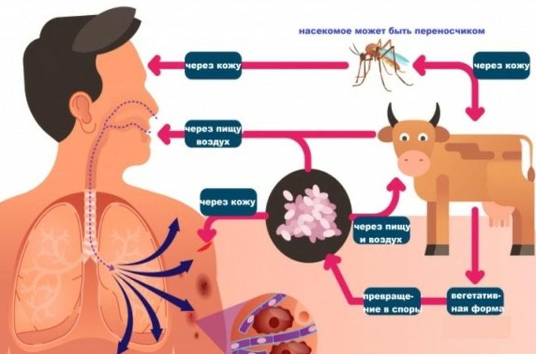 Что такое сибирская язва?