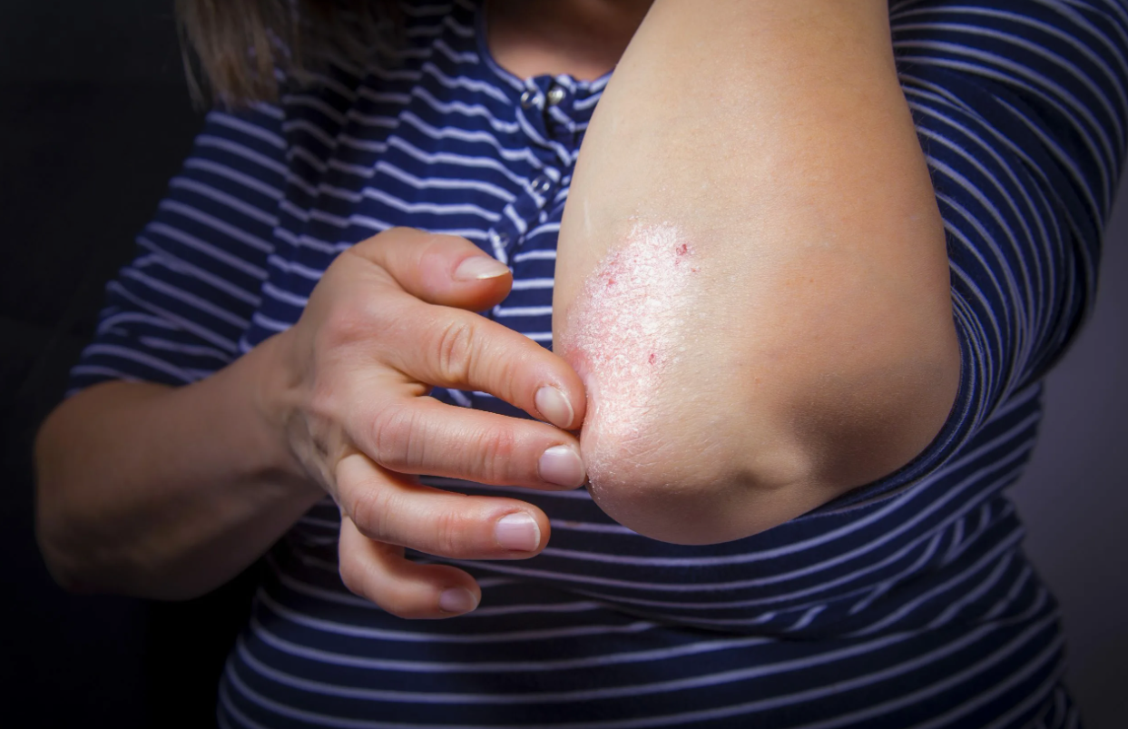 29 октября – Всемирный день борьбы с псориазом