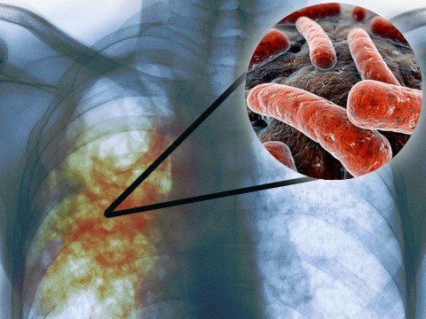 Всемирный день борьбы с туберкулёзом
